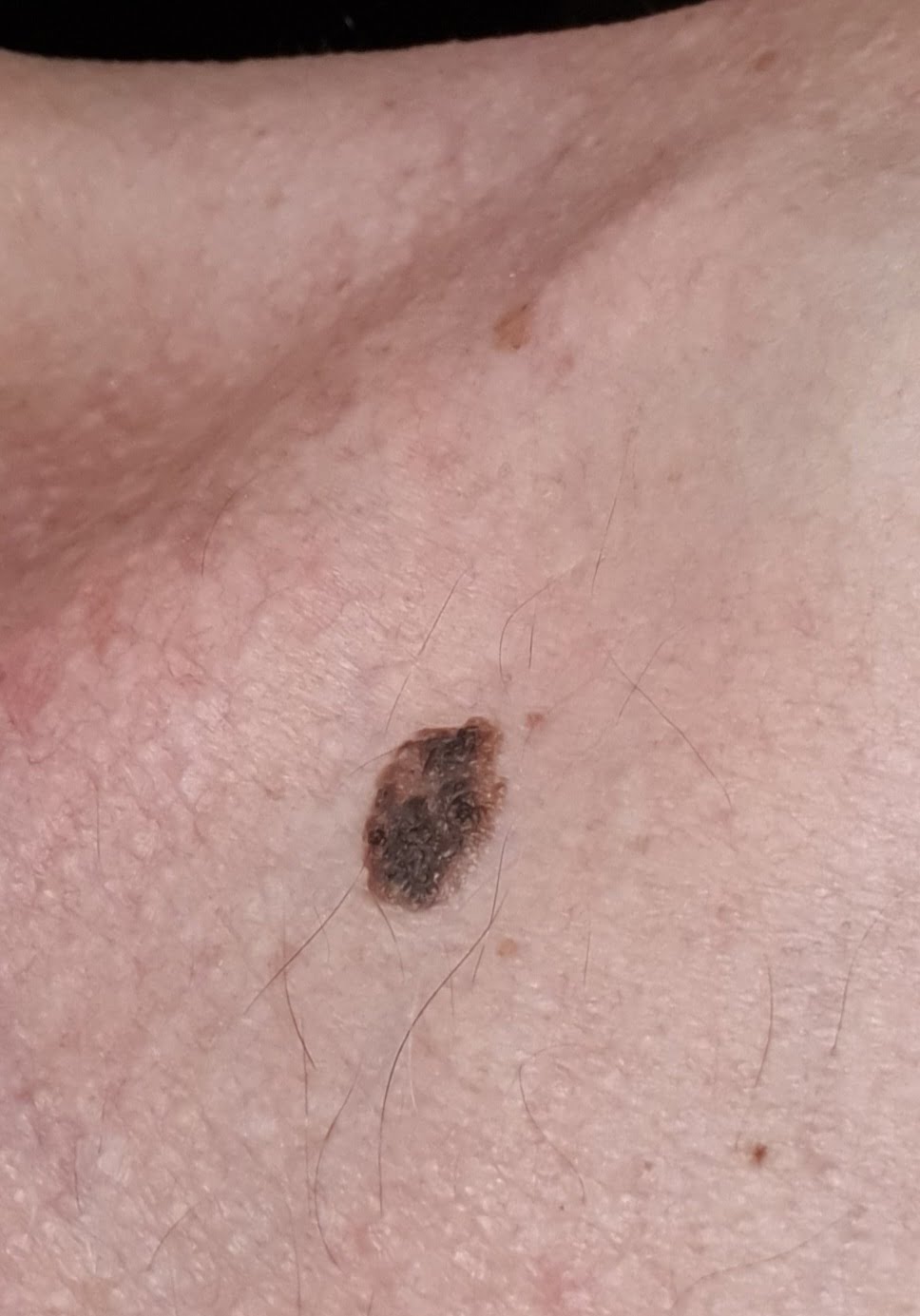Mastocytes Tissulaires Verrues S borrh iques Et Sels De La Mer Morte